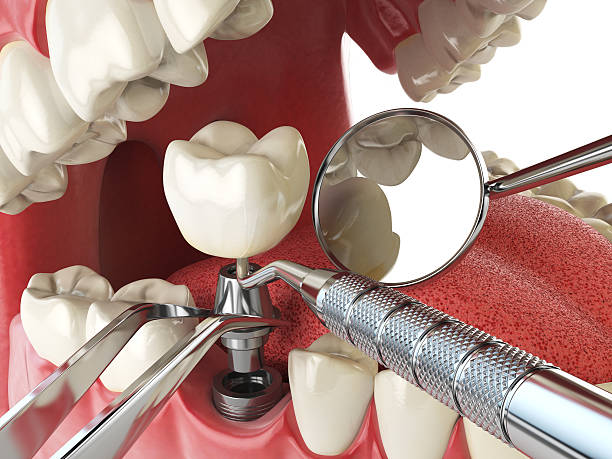 Best Emergency Dental Care for Broken or Chipped Teeth in Coral Springs, FL